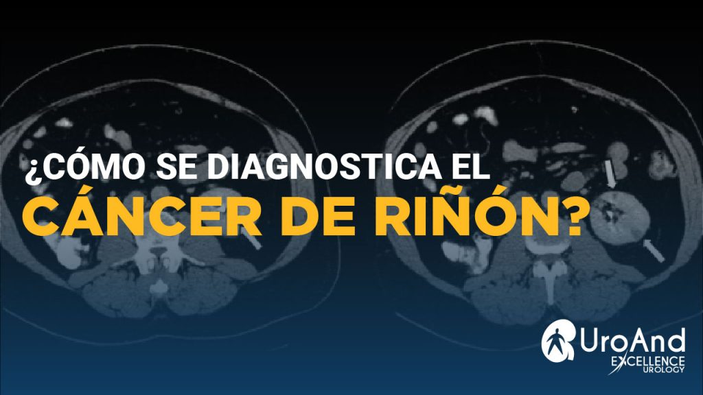 diagnostico cancer de rinon excellence urology 37
